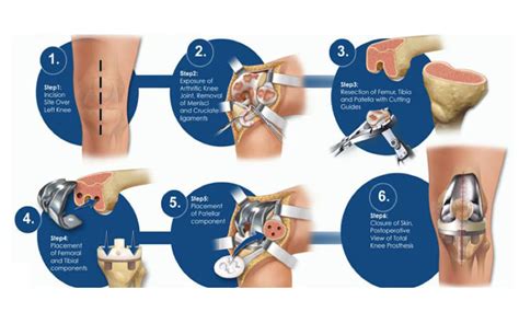 Nursing intervention using healing touch in total knee replacement.